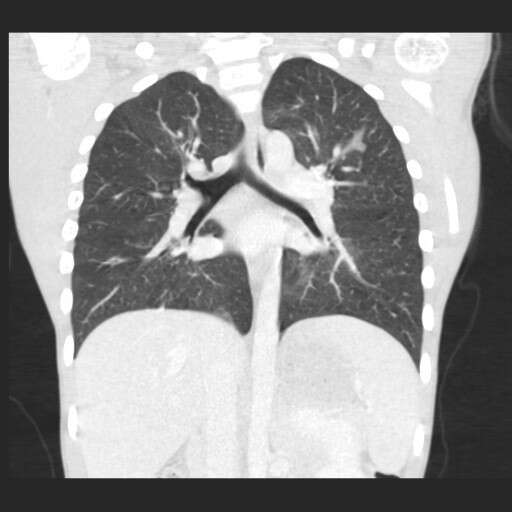 Chest CT scan showing enlarged lymph nodes